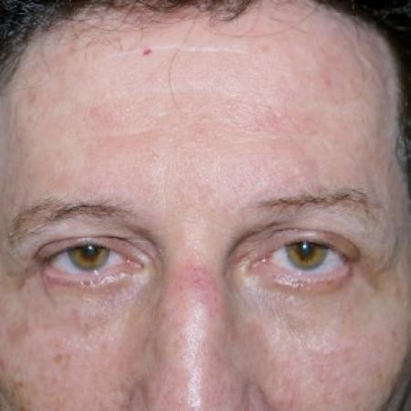 After image 1 Case #82446 - Blepharoplasty