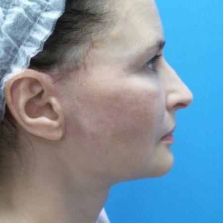 After image 3 Case #86976 - 57 year old  -  Facelift/Submental Liposuction  -  2 months post-op