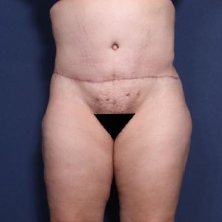 After image 1 Case #83571 - 36 Years Old Female 