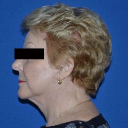 After image 2 Case #86796 - Full Facelift