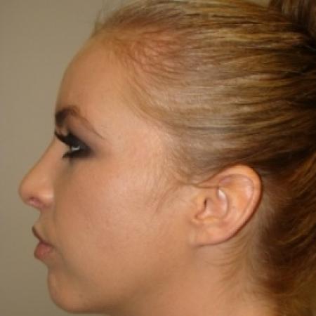 After image 3 Case #80476 - Open Rhinoplasty