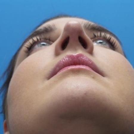 After image 4 Case #86551 - Rhinoplasty  3 months post-op