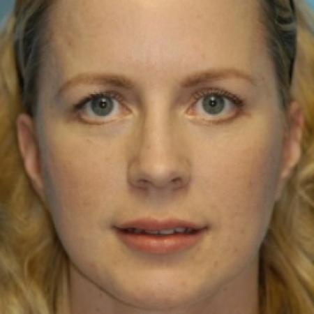 After image 1 Case #79676 - Lip Grafting