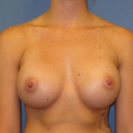 After image 1 Case #80676 - Breast Augmentation