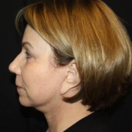 After image 3 Case #85231 - Facelift/Facial Rejuvenation - 64 year old female