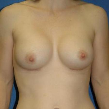 After image 1 Case #80886 - Breast Augmentation 