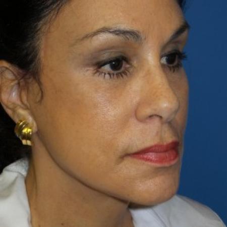 After image 2 Case #86611 - Facelift/Lower Blepharoplasty/Browlift     3 months post-op