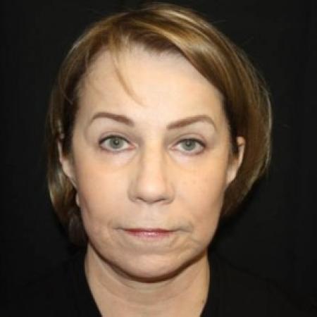After image 1 Case #85231 - Facelift/Facial Rejuvenation - 64 year old female
