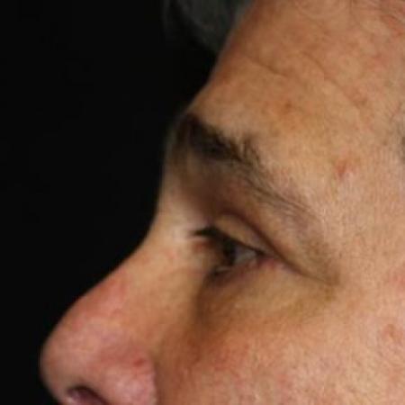 After image 3 Case #84216 - Blepharoplasty - 61 year old male
