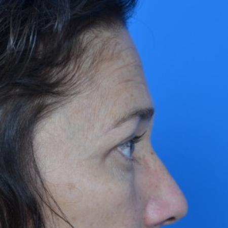 After image 2 Case #87896 - Upper Eyelid Surgery (blepharoplasty)