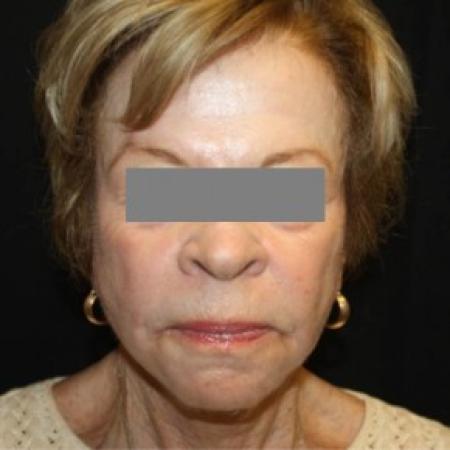 After image 1 Case #85601 - Phenol and Croton Oil Peel - 76 year old female