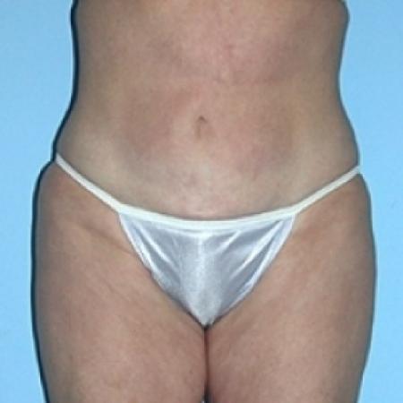 After image 1 Case #79246 - Liposuction