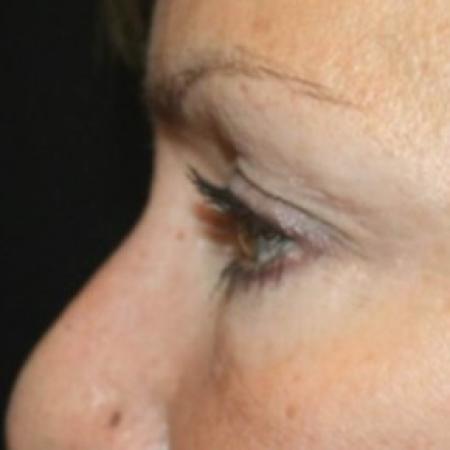 After image 3 Case #83456 - Blepharoplasty - 57 year old female.