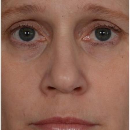After image 1 Case #86321 - 50 year old woman treated with nonsurgical rhinoplasty
