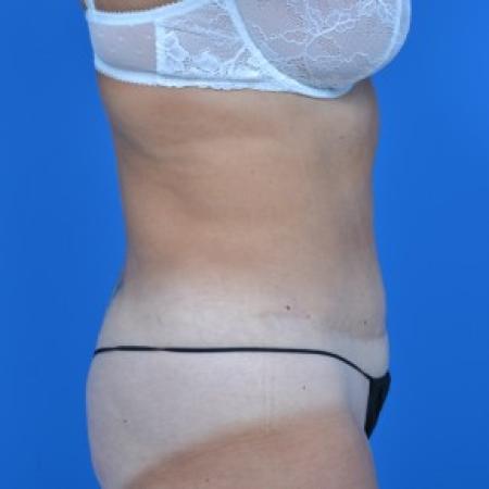After image 2 Case #87876 - Tummy Tuck