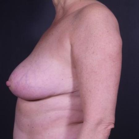 After image 2 Case #83786 - Implant Removal