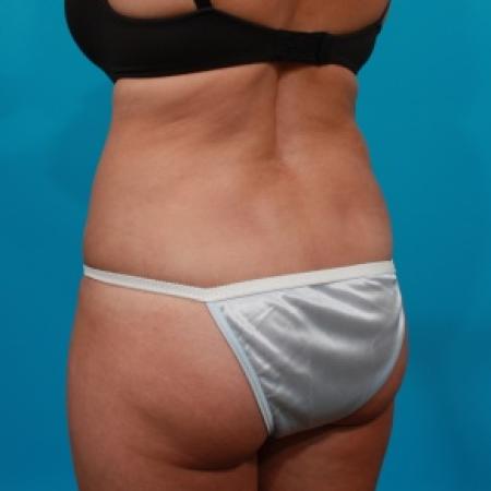 After image 4 Case #80771 - Tummy Tuck & Flank Liposuction