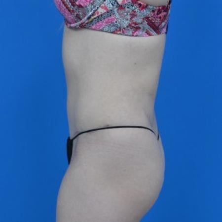 After image 2 Case #87946 - Tummy Tuck