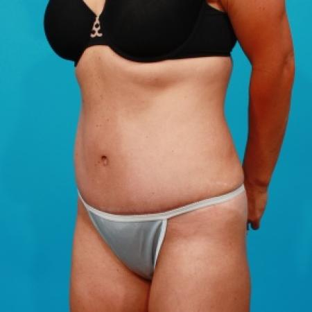 After image 2 Case #80741 - Tummy Tuck