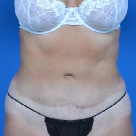 After image 1 Case #87876 - Tummy Tuck