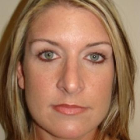 After image 1 Case #79536 - Rhinoplasty