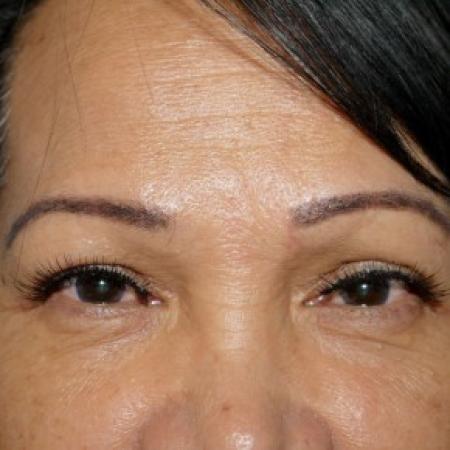 After image 1 Case #82481 - Upper Blepharoplasty
