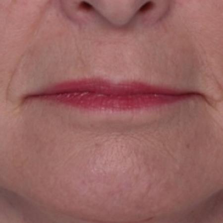 After Case #80576 - Lip Augmentation