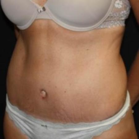 After image 2 Case #84291 - Abdominoplasty - 39 year old female