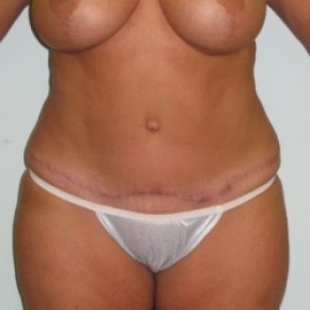 After image 1 Case #79916 - Tummy Tuck