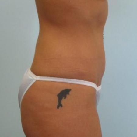 After image 2 Case #82606 - Tummy Tuck after Weight Loss