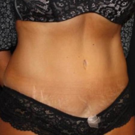After image 2 Case #84891 - Abdominoplasty - 39 year old female