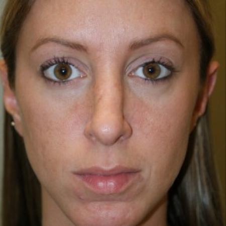 After image 1 Case #81891 - Open Structure Septorhinoplasty