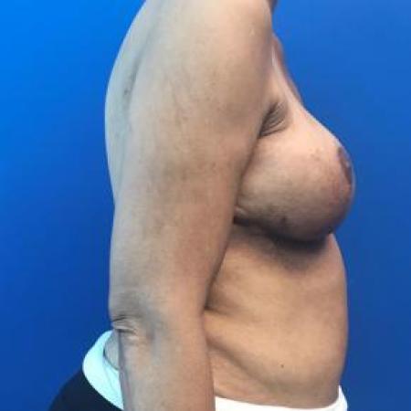 After image 2 Case #88386 - DIEP Flap Breast Reconstruction on a 66 year old female 