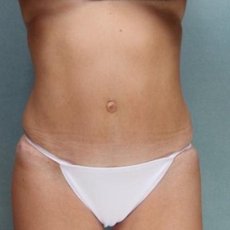 After image 1 Case #86776 - Tummy Tuck (Abdominoplasty)