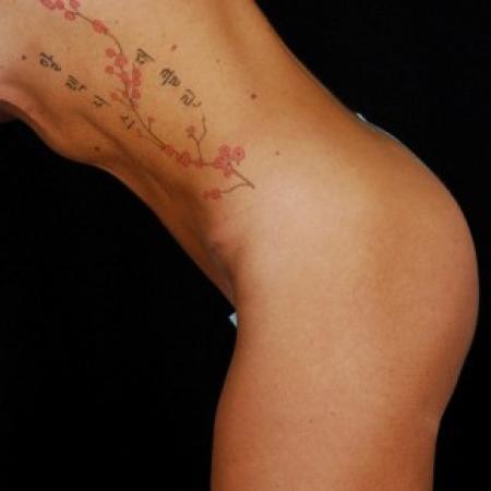 After image 4 Case #81571 - Tummy Tuck