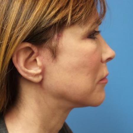 After image 3 Case #86561 - Facelift/ Upper Blepharoplasty/Laser Resurfacing to Full Face     2 months post-op