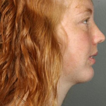 After image 2 Case #83621 - Liposuction Neck with Chin Implant