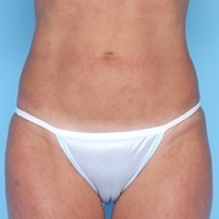 After image 1 Case #79241 - Liposuction