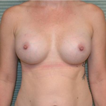 After image 1 Case #87806 - Breast Augmentation with Mentor MemoryGel Smooth Round Moderate Plus Profile 325cc gel breast implants.
