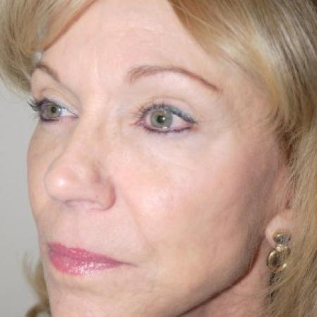 After image 2 Case #82441 - 56 year old with facial wrinkles, history of acne scarring