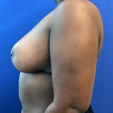 After image 2 Case #88266 - Breast reduction on a 47 year old female
