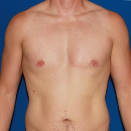 After image 1 Case #79986 - Gynecomastia male breast reduction