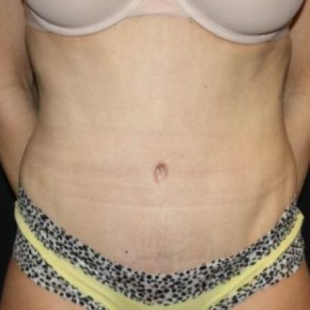 After image 1 Case #84221 - Abdominoplasty, plication of rectus diastasis, ventral hernia repair - 35 year old female