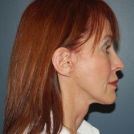After image 2 Case #81031 - Facelift