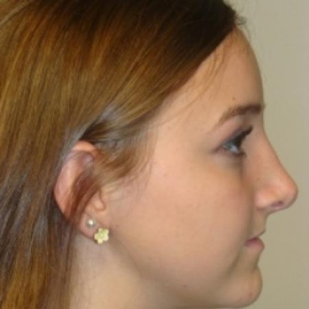 After image 2 Case #80406 - Open Rhinoplasty