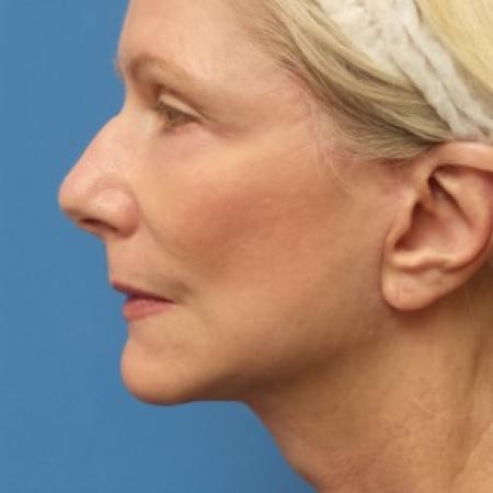 After image 3 Case #86581 - Facelift/Upper Blepharoplasty     2 months post-op