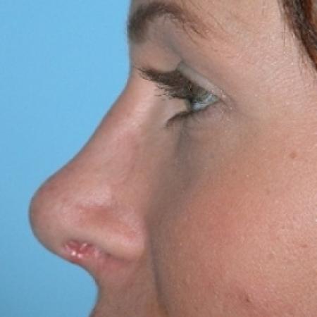 After image 2 Case #79251 - Rhinoplasty