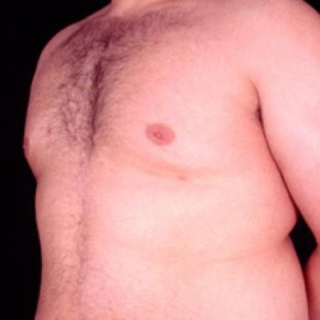 After image 2 Case #81511 - Gynecomastia