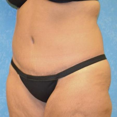 After image 1 Case #81391 - Circumferential body lift with abdominal wall plication