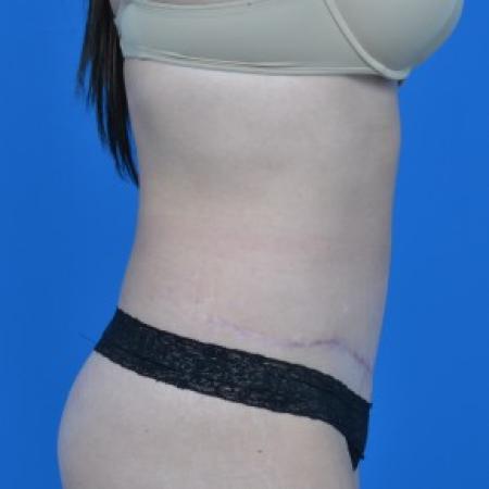 After image 2 Case #87846 - Tummy Tuck